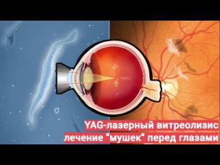 YAG-лазерный витреолизис - метод лечение мушек перед глазами (ДСТ) - “живое видео“ операции