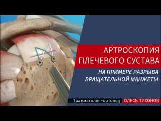 Артроскопическая операция на плече при разрыве вращательной манжеты плеча