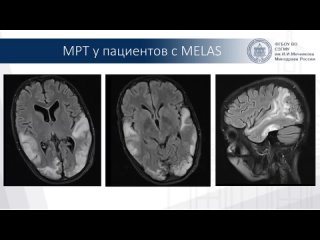 ЦЕРЕБРАЛЬНЫЕ ИНСУЛЬТЫ У МОЛОДЫХ ПАЦИЕНТОВ