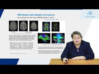 Dambinova Svetlana: AMPA and NMDA receptors in diagnosis of sport-related concussions