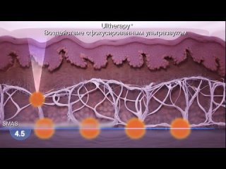 УЛЬТРАЗВУКОВОЙ ЛИФТИНГ  Безоперационный SMAS лифтинг за одну процедуру