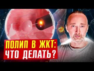 Полипы в кишечнике: Защита, лечение и как не допустить РАК в ЖКТ