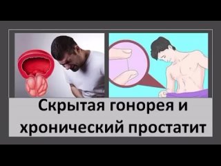 Скрытая гонорея и хронический простатит