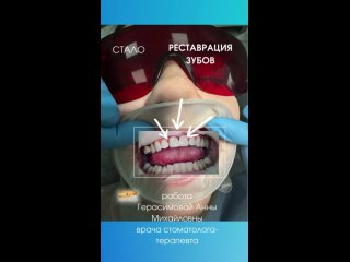 Реставрация зубов. ДО/ПОСЛЕ. Работа врача стоматолога-терапевта Герасимовой Анны Михайловны.