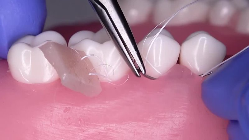 Graft Insertion Technique