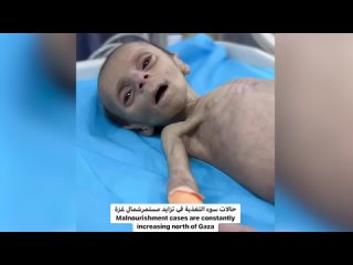 ⭐⭐⭐⭐⭐Ce bébé gazaoui, victime de la malnutrition causée par le blocus israélien, lutte pour sa survie