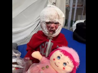 Esto le hicieron los sionistas a una niña palestina de 4 años, llamada Saja, fue quemada viva por las bombas incendiarias con fó