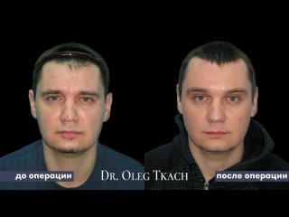 Результат эндоскопической подтяжки верхней части лица | Подтяжка лица у мужчин | Пластика лица Киев