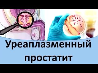 Уреаплазменный простатит