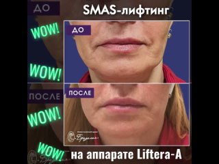 SMAS-лифтинг на аппарате Liftera-A, подтяжка лица.mp4