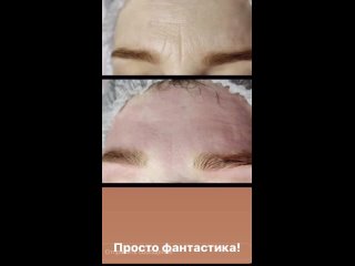Видео от Аппаратный массаж • косметология Кунгур Пермь
