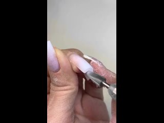 Восстановление клюющего ногтя с разросшимся гипонихием