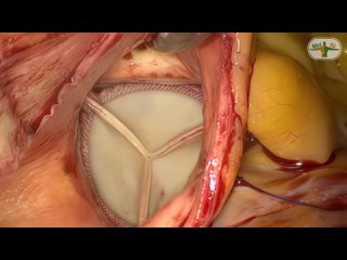 Замена аортального клапана через мини-доступы
