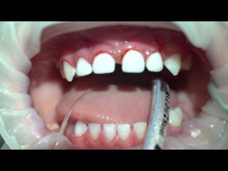 Лечение кариеса молочных зубов в наркозе