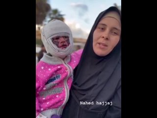 ‼️ La niña palestina Saja, de 4 años, sufrió graves quemaduras en la cara después de que su casa fuera atacada por los aviones d