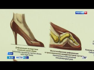 Подолог: «Ношение неправильно подобранной обуви может привести и к развитию плоскостопия»