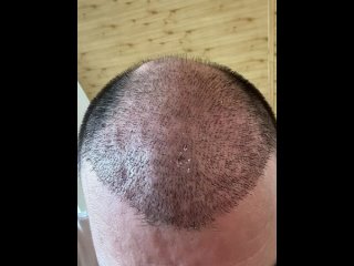 Видео от TurkeyEsteHair - пересадка волос