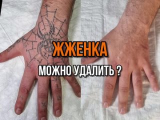 Удаление тату Ульяновск, студия Игоря Борисова