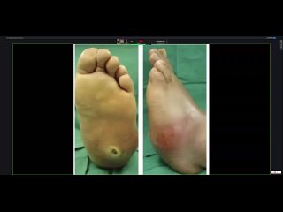 year old Mr Faisal presented with complaints of foot ulcer and difficultly in walking