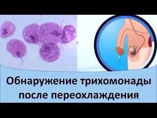 Обнаружение трихомонады после переохлаждения.