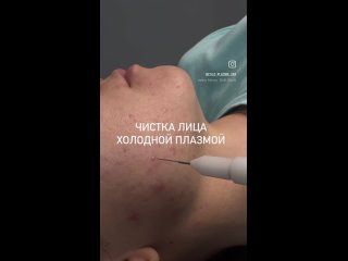 Аппаратная косметология Уфа, Холодная плазмаtan video