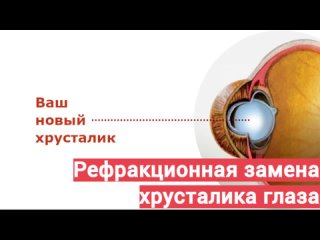 Рефракционная замена собственного хрусталика глаза на ИОЛ (РЗХ)- инфографика операции