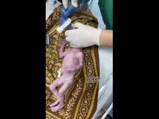 Rescatando a un feto del vientre de su madre despus de haber sido brutalmente asesinado como resultado de la criminal ocupaci