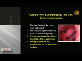 Endometrial polyps and the risk of cancer can we make a judgment on whether to remove them or should they all be excised