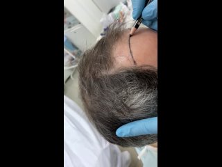 Видео от Пересадка волос в HAIR TRANS LAB