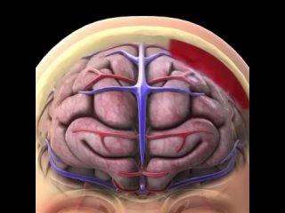 Как случаются сотрясения.Сотрясение мозга  это тип черепно-мозговои травмы (ЧМТ), вызванныи ударом или толчком по голове