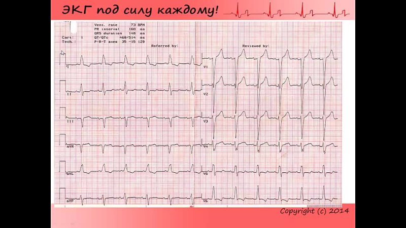 Урок 7. Видеокурс 'ЭКГ под силу каждому'.