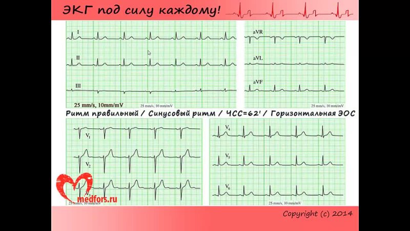 Урок 4. Видеокурс 'ЭКГ под силу каждому'.