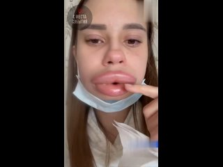 Жительница Владикавказа попыталась «сдуть» увеличенные губы и столкнулась с тяжелой аллергической реакцией: отек Квинке... (видео)