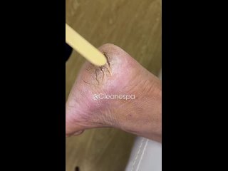 Восстановление пяточек (видео)