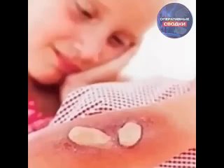 Ребёнок из детского сада доставлен в больницу на скорой. По словам родителей, администрация пыталась замять инцидент. ... (видео)