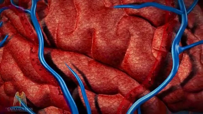 3 D Medical Animation ( HD) Arteriovenous Malformation ( Brain