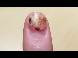 Восстановление отбитого ногтя
