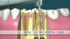 root canal treatment demo