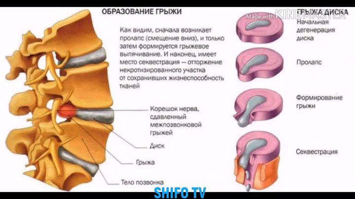 Грыжи диска сегменты