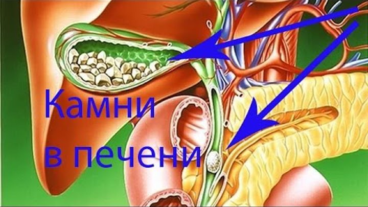 видео чистки печени. очищение печени дюбажем. чистка печени по малахову с свеклой в домашних. матрицы для очищения печени. видео чистки печени.
