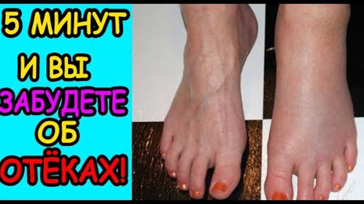 💥КАК БЫСТРО СНЯТЬ ОТЁЧНОСТЬ НОГ! ЛЕЧИМ ОТЕК НОГ ДОМА!