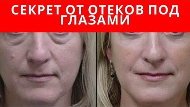 Как быстро снять отек после