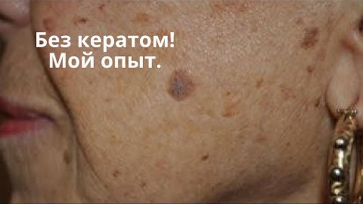 Как выглядит кератома на коже у человека Старческое лентиго: заболевание или эстетический недостаток, как избавиться от п