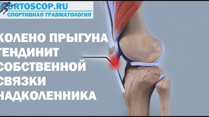 тендинит собственной связки надколенника. тендинопатия связки надколенника. тендиноз собственной связки надколенника. тендиноз связки надколенника это. тендиноз собственной связи надколенника.