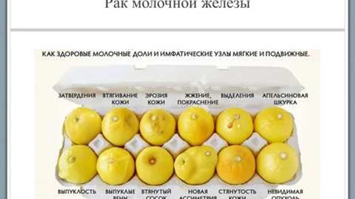 Как выглядит грудь при раке молочной железы