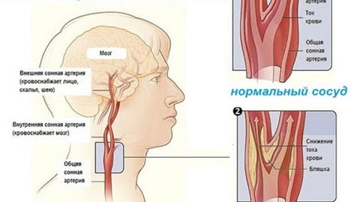 Лекарство спазма сосудов мозга