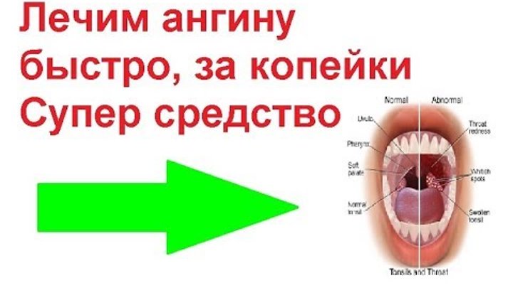Как быстро снять воспаление горла при ангине