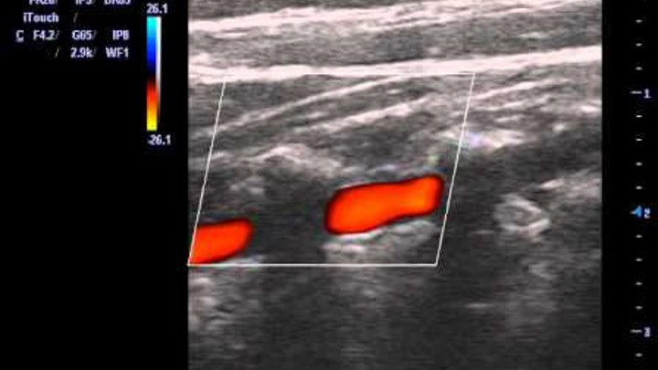 узи шейных артерий позвоночника. ультразвуковая допплерография сосудов головного мозга. узи позвоночных сосудов. узи позвоночных сосудов. гипоплазия v4 сегмента позвоночной артерии.
