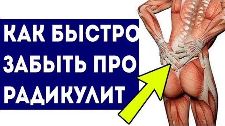 Как быстро снять радикулит