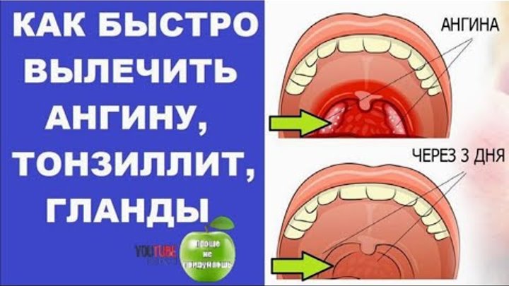 Ангина лечение у взрослых фото
